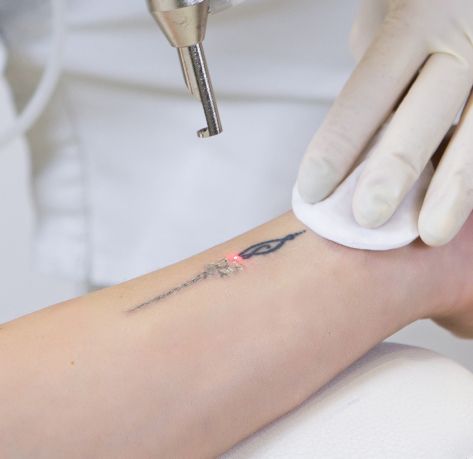 Imagem que representa a cirurgia de Ninfoplastia